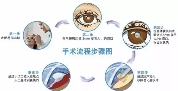 12月23日，普瑞眼科白內障患者答謝會邀您參加!